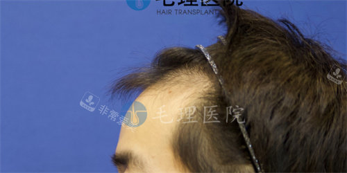 發(fā)際線植發(fā)后圖片 發(fā)際線植發(fā)后圖片