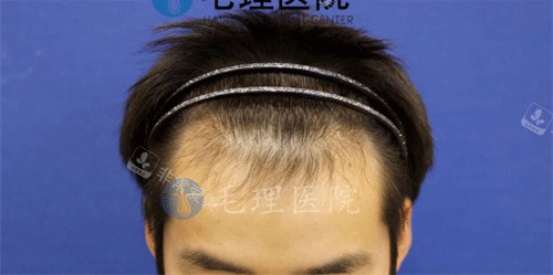 發(fā)際線植發(fā)后圖片 發(fā)際線植發(fā)后圖片