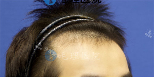 發(fā)際線植發(fā)后圖片 發(fā)際線植發(fā)后圖片