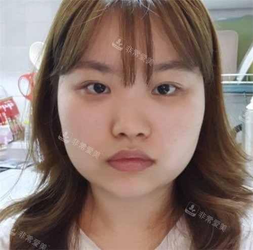 面部輪廓整形前照片 面部輪廓整形前照片