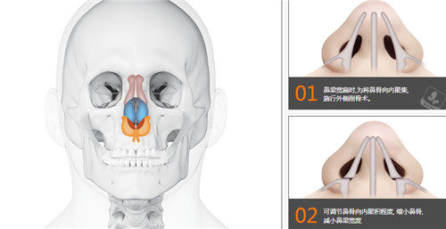 鼻骨手术图片