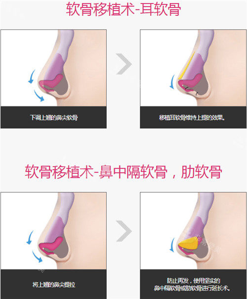 耳移植手術(shù)細節(jié)圖