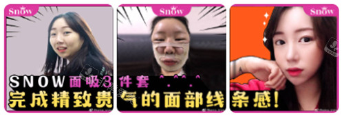 韓國SNOW整形外科面部吸脂對比照 韓國SNOW整形外科面部吸脂對比照