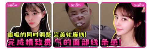 韓國SNOW整形外科面部吸脂前后圖
