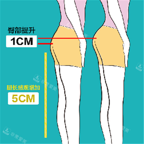 北京禾美嘉醫(yī)美豐臀手術(shù)臀部提升動(dòng)畫對比