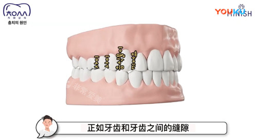 容易長蛀牙的部位展示