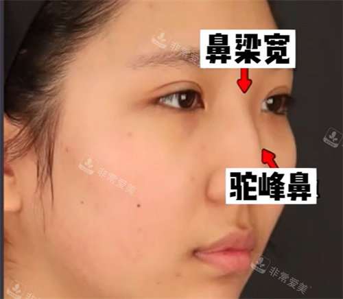 鼻整形手术术前 鼻整形手术术前