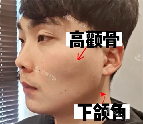 颧骨,下颌角整形手术前 颧骨,下颌角整形手术前