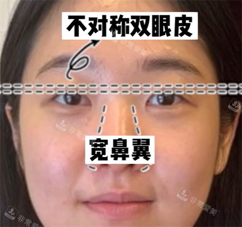 不对称双眼皮 ,宽鼻翼矫正手术前 不对称双眼皮 ,宽鼻翼矫正手术前