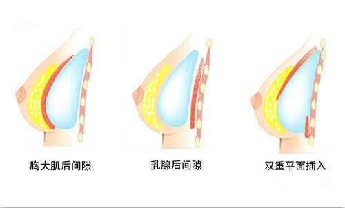 假体植入方式示意图