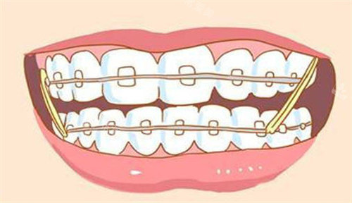 牙齿矫正动画展示图
