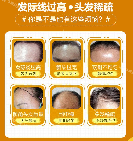 不同部位的脫發(fā)情況展示 不同部位的脫發(fā)情況展示