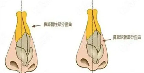 鼻修复图片