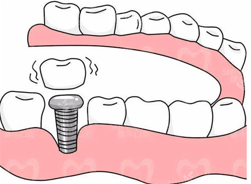 种植牙多少钱一颗，半口牙种植需要多少钱？