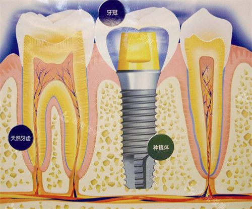 种植牙牙冠和种植体图片