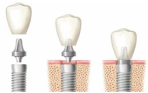 种植牙展示图