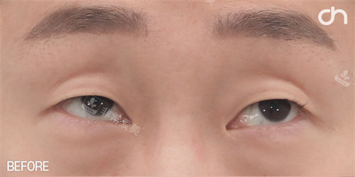 雙眼皮手術(shù)前照片 雙眼皮手術(shù)前照片