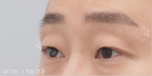 雙眼皮手術(shù)后照片 雙眼皮手術(shù)后照片