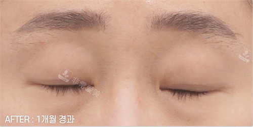 雙眼皮手術(shù)后照片 雙眼皮手術(shù)后照片
