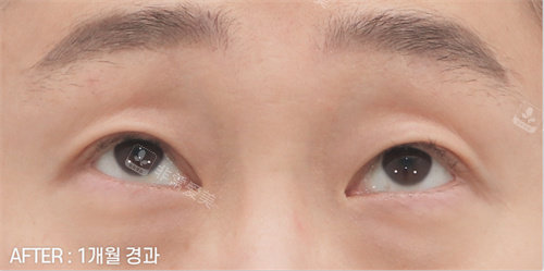 雙眼皮手術(shù)后照片 雙眼皮手術(shù)后照片