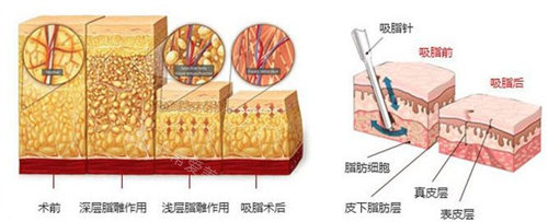 吸脂圖