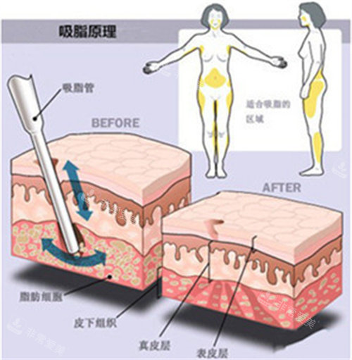 吸脂原理图