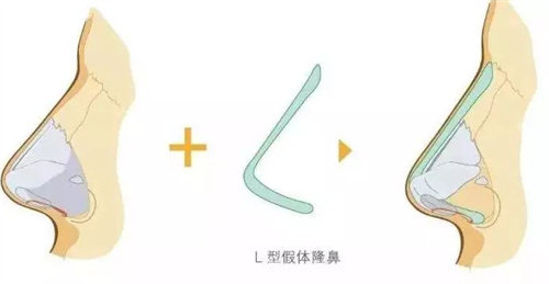 L型假体动画展示图 L型假体动画展示图