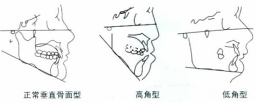 輪廓手術(shù)圖
