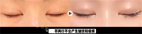 韓國(guó)TS整形醫(yī)院眼修復(fù)對(duì)比圖
