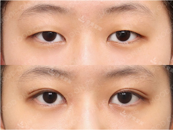 MOODON整形外科埋線雙眼皮手術圖片 MOODON整形外科埋線雙眼皮手術圖片