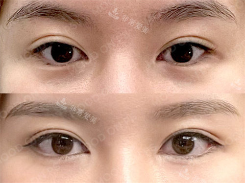 韓國(guó)MOODON整形外科開(kāi)眼角對(duì)比圖 韓國(guó)MOODON整形外科開(kāi)眼角對(duì)比圖