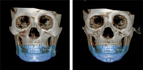 韩国绮林整形下颌角手术ct