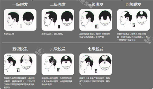 脫發(fā)等級展示圖 脫發(fā)等級展示圖