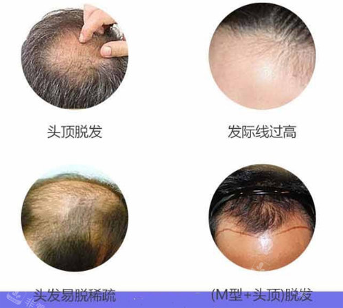 不同脫發(fā)部位圖 不同脫發(fā)部位圖