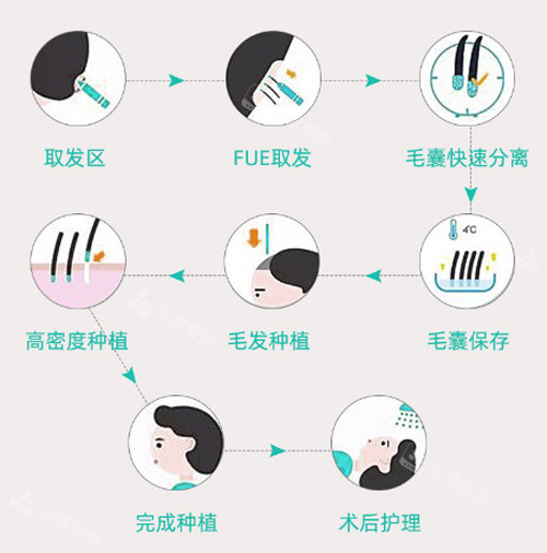 毛发移植过程图