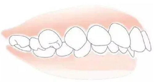 成人龅牙可以矫正回来吗？揭晓成人龅牙矫正详细方案！