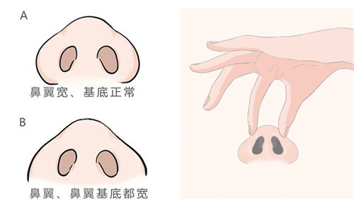 鼻基底手术动画图 鼻基底手术动画图
