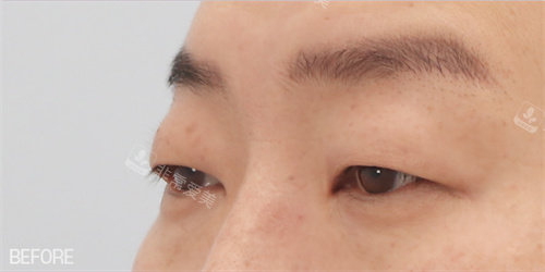 雙眼皮前照片 雙眼皮前照片