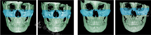 韩国绮林整形磨骨手术ct照片