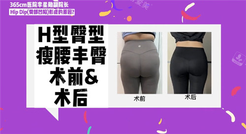 H型臀部術(shù)前術(shù)后對(duì)比照