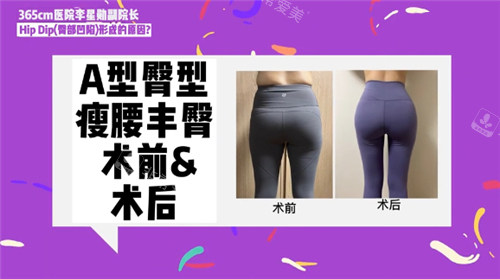 A型臀術(shù)前術(shù)后對(duì)比照