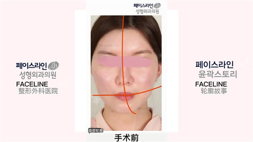 韩国faceline整形医院案例展示