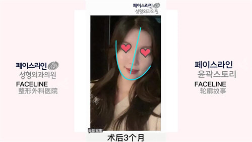 韩国faceline整形医院轮廓术后