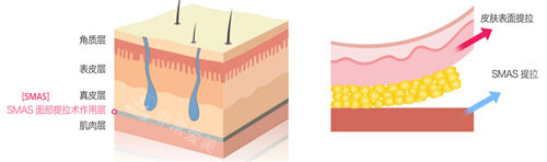 smas筋膜層動(dòng)畫說明圖