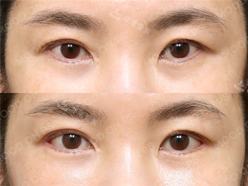 1679554075363355.jpg 內(nèi)眼角+外眼角.jpg