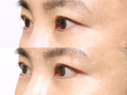 1679554081233437.jpg 內(nèi)外眼角45度.jpg