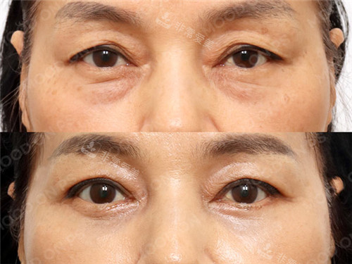1679554692642734.jpg 上眼瞼,下眼瞼.jpg