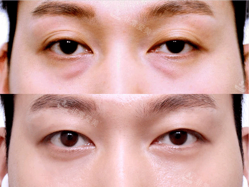 男士眼睛整形手術(shù)照片 男士眼睛整形手術(shù)照片