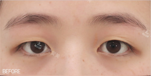 雙眼皮術(shù)前照片 雙眼皮術(shù)前照片