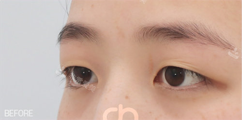 雙眼皮術(shù)前照片 雙眼皮術(shù)前照片